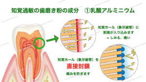 知覚過敏の歯磨き粉成分　乳酸アルミニウム